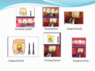 Gingival bevels
Proximal box
Prepared cavityOcclusal bevels
Occlusal outline Gingival bevels
 
