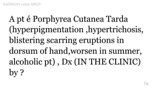 A pt é Porphyrea Cutanea Tarda
(hyperpigmentation ,hypertrichosis,
blistering scarring eruptions in
dorsum of hand,worsen ...
