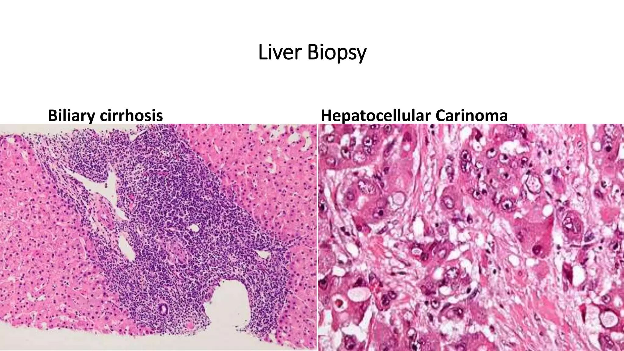 viral markers in diagnosis monitoring and treatment of hepatitis b and ...