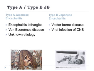 Type A / Type B JE
Type A Japanese
Encephalitis
Type B Japanese
Encephalitis
 Encephalitis lethargica
 Von Economos disease
 Unknown etiology
 Vector borne disease
 Viral infection of CNS
 