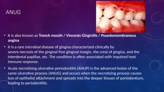 gingival diseases of periodontium 1.pptx