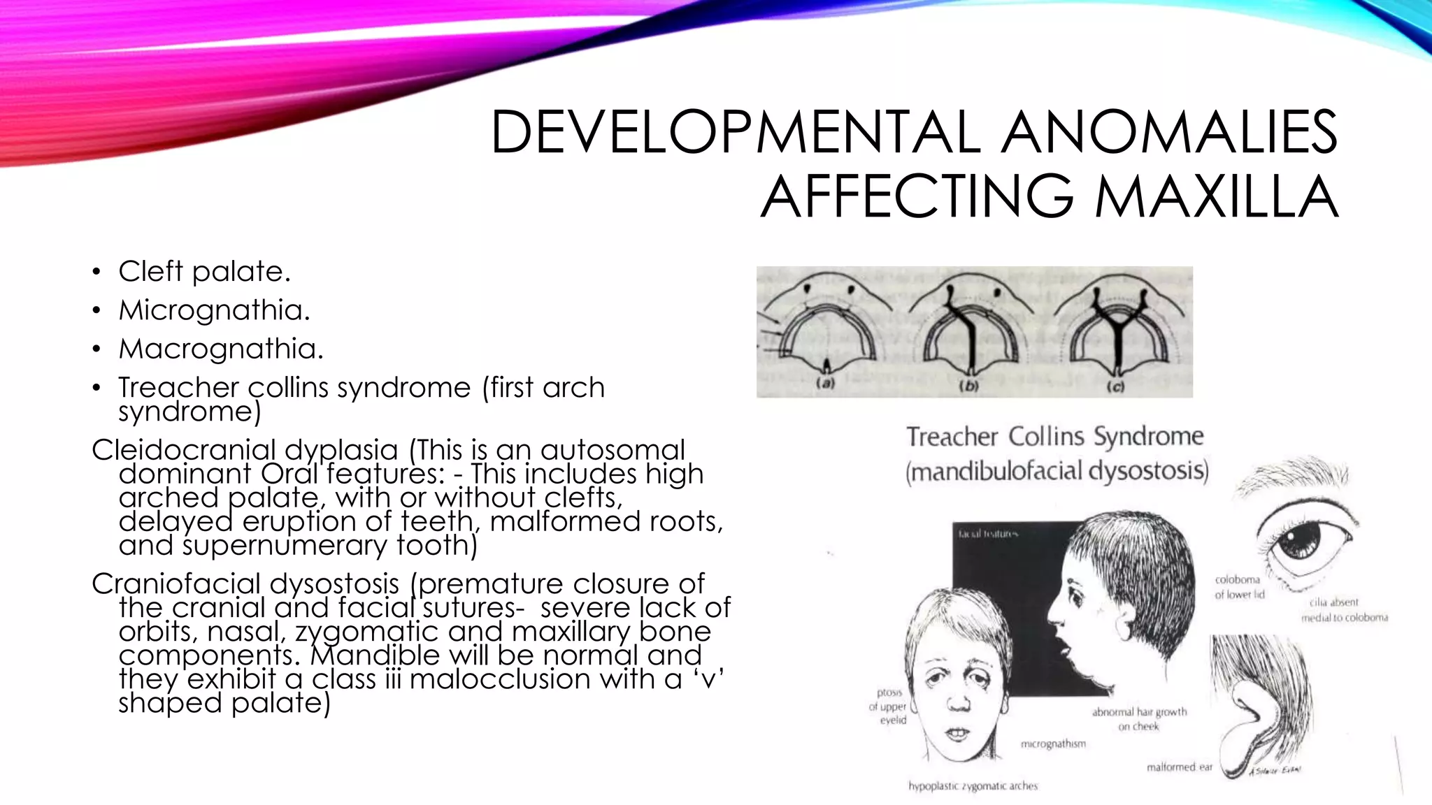DEVELOPMENTAL ANOMALIES 
AFFECTING MAXILLA 
• Cleft palate. 
• Micrognathia. 
• Macrognathia. 
• Treacher collins syndrome (first arch 
syndrome) 
Cleidocranial dyplasia (This is an autosomal 
dominant Oral features: - This includes high 
arched palate, with or without clefts, 
delayed eruption of teeth, malformed roots, 
and supernumerary tooth) 
Craniofacial dysostosis (premature closure of 
the cranial and facial sutures- severe lack of 
orbits, nasal, zygomatic and maxillary bone 
components. Mandible will be normal and 
they exhibit a class iii malocclusion with a ‘v’ 
shaped palate) 
 