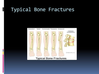 Typical Bone Fractures