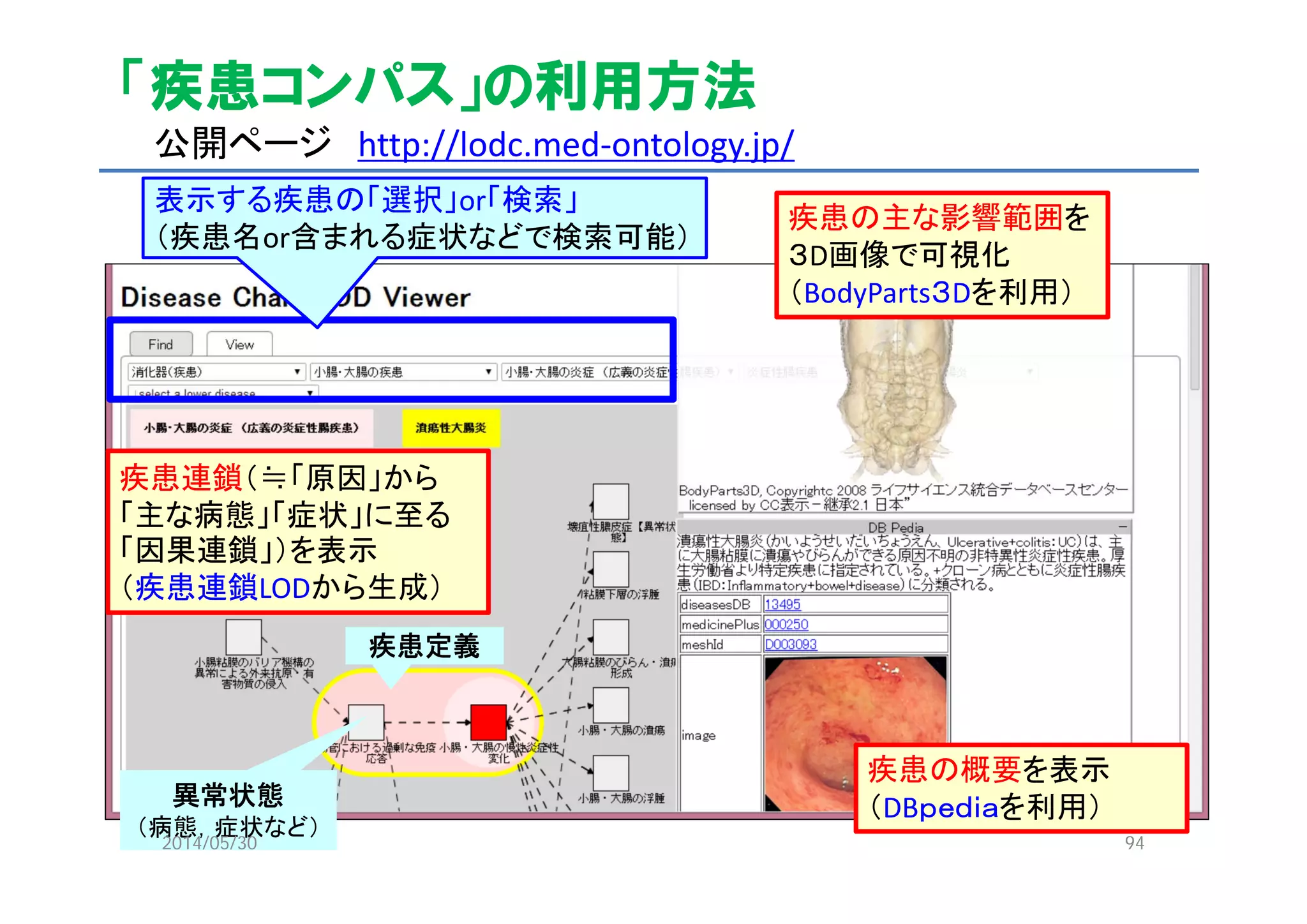 「疾患コンパス」の利用方法
公開ページ http://lodc.med‐ontology.jp/
表示する疾患の「選択」or「検索」
（疾患名or含まれる症状などで検索可能）
疾患連鎖（≒「原因」から
「主な病態」「症状」に至る
「因果連鎖」）を表示
（疾患連鎖LODから生成）
疾患の主な影響範囲を
３D画像で可視化
（BodyParts３Dを利用）
疾患の概要を表示
（DBｐｅｄｉａを利用）
疾患定義
異常状態
（病態，症状など）
2014/05/30 94
 