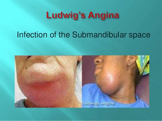 ludwig s angina