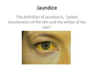 Jaundice
     The definition of jaundice is, “yellow
discoloration of the skin and the whites of the
                     eyes”
 