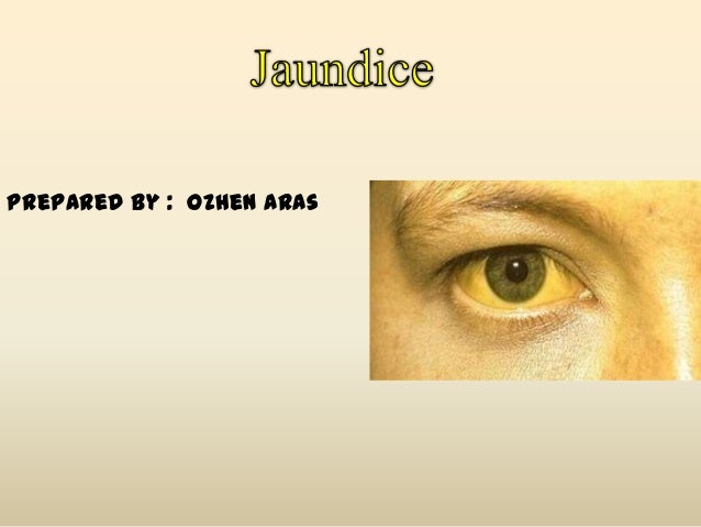 jaundice case presentation slideshare