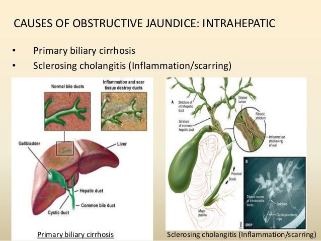 obstructive jaundice