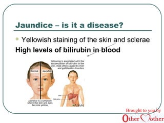 Jaundice – is it a disease? 
Yellowish staining of the skin and sclerae 
High levels of bilirubin in blood 
Brought to you by 
 