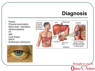  History 
 Physical examination 
 Blood tests - laboratory 
 Ultrasonography 
 CT 
 MRI 
 Liver biopsy 
 ERCP 
 Endoscopic ultrasound 
Diagnosis 
Brought to you by 
 