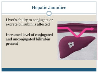 Hepatic Jaundice
Liver’s ability to conjugate or
excrete bilirubin is affected
Increased level of conjugated
and unconjugated bilirubin
present
 