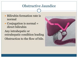 Obstructive Jaundice
 Bilirubin formation rate is
normal
 Conjugation is normal =
direct bilirubin
Any intrahepatic or
extrahepatic condition leading
Obstruction to the flow of bile.
 