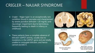 CRIGLER – NAJJAR SYNDROME
 Crigler - Najjar type I is an exceptionally rare
condition found in neonates and characterized
by severe jaundice (bilirubin >20 mg/dL) and
neurologic impairment due to kernicterus,
frequently leading to death in infancy or
childhood.
 These patients have a complete absence of
bilirubin UDPGT activity, usually due to
mutations in the UDPGT gene and are totally
unable to conjugate bilirubin, and hence
cannot excrete it.
 