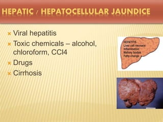 HEPATIC / HEPATOCELLULAR JAUNDICE
 Viral hepatitis
 Toxic chemicals – alcohol,
chloroform, CCl4
 Drugs
 Cirrhosis
 