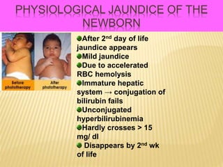PHYSIOLOGICAL JAUNDICE OF THE
NEWBORN
After 2nd day of life
jaundice appears
Mild jaundice
Due to accelerated
RBC hemolysis
Immature hepatic
system → conjugation of
bilirubin fails
Unconjugated
hyperbilirubinemia
Hardly crosses > 15
mg/ dl
Disappears by 2nd wk
of life
 