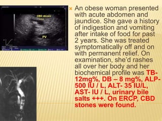  An obese woman presented
with acute abdomen and
jaundice. She gave a history
of indigestion and vomiting
after intake of food for past
2 years. She was treated
symptomatically off and on
with permanent relief. On
examination, she’d rashes
all over her body and her
biochemical profile was TB-
12mg%, DB – 8 mg%, ALP-
500 IU / L, ALT- 35 IU/L,
AST- IU / L, urinary bile
salts +++. On ERCP, CBD
stones were found.
 
