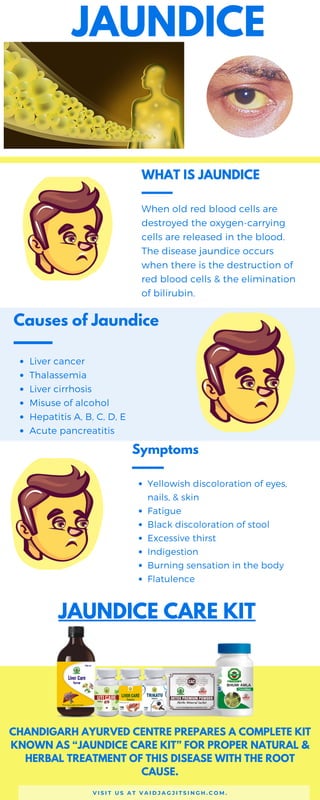 WHAT IS JAUNDICE
When old red blood cells are
destroyed the oxygen-carrying
cells are released in the blood.
The disease jaundice occurs
when there is the destruction of
red blood cells & the elimination
of bilirubin.
Causes of Jaundice
Liver cancer
Thalassemia
Liver cirrhosis
Misuse of alcohol
Hepatitis A, B, C, D, E
Acute pancreatitis
Symptoms
Yellowish discoloration of eyes,
nails, & skin
Fatigue
Black discoloration of stool
Excessive thirst
Indigestion
Burning sensation in the body
Flatulence
JAUNDICE
V I S I T U S A T V A I D J A G J I T S I N G H . C O M .
JAUNDICE CARE KIT
CHANDIGARH AYURVED CENTRE PREPARES A COMPLETE KIT
KNOWN AS “JAUNDICE CARE KIT” FOR PROPER NATURAL &
HERBAL TREATMENT OF THIS DISEASE WITH THE ROOT
CAUSE.
 