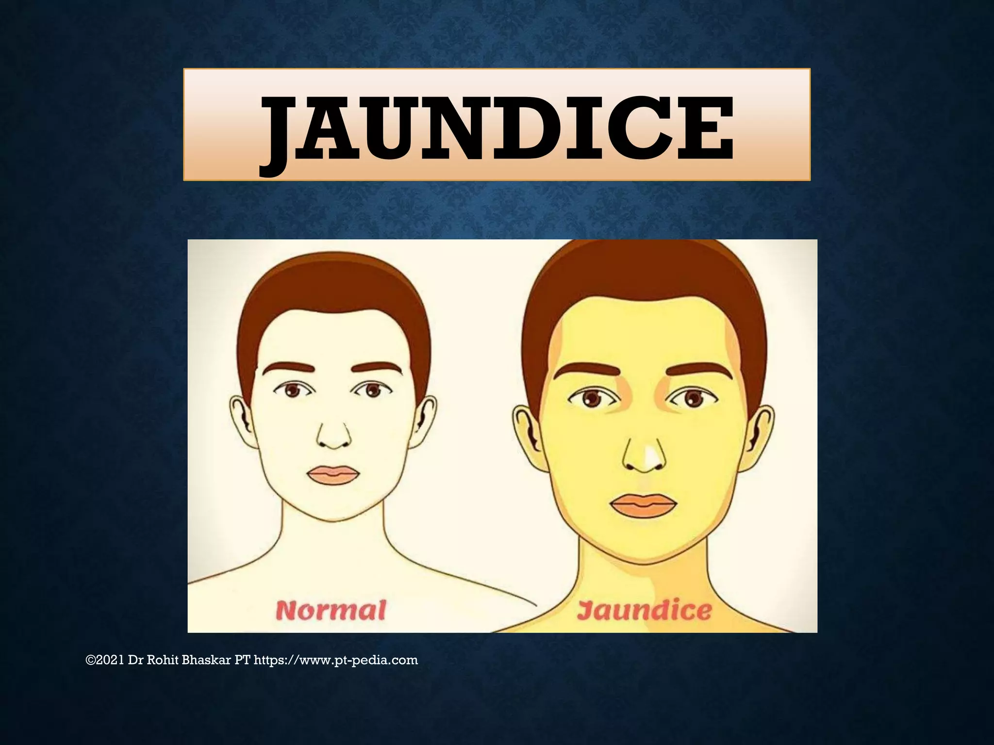 JAUNDICE
©2021 Dr Rohit Bhaskar PT https://www.pt-pedia.com
 