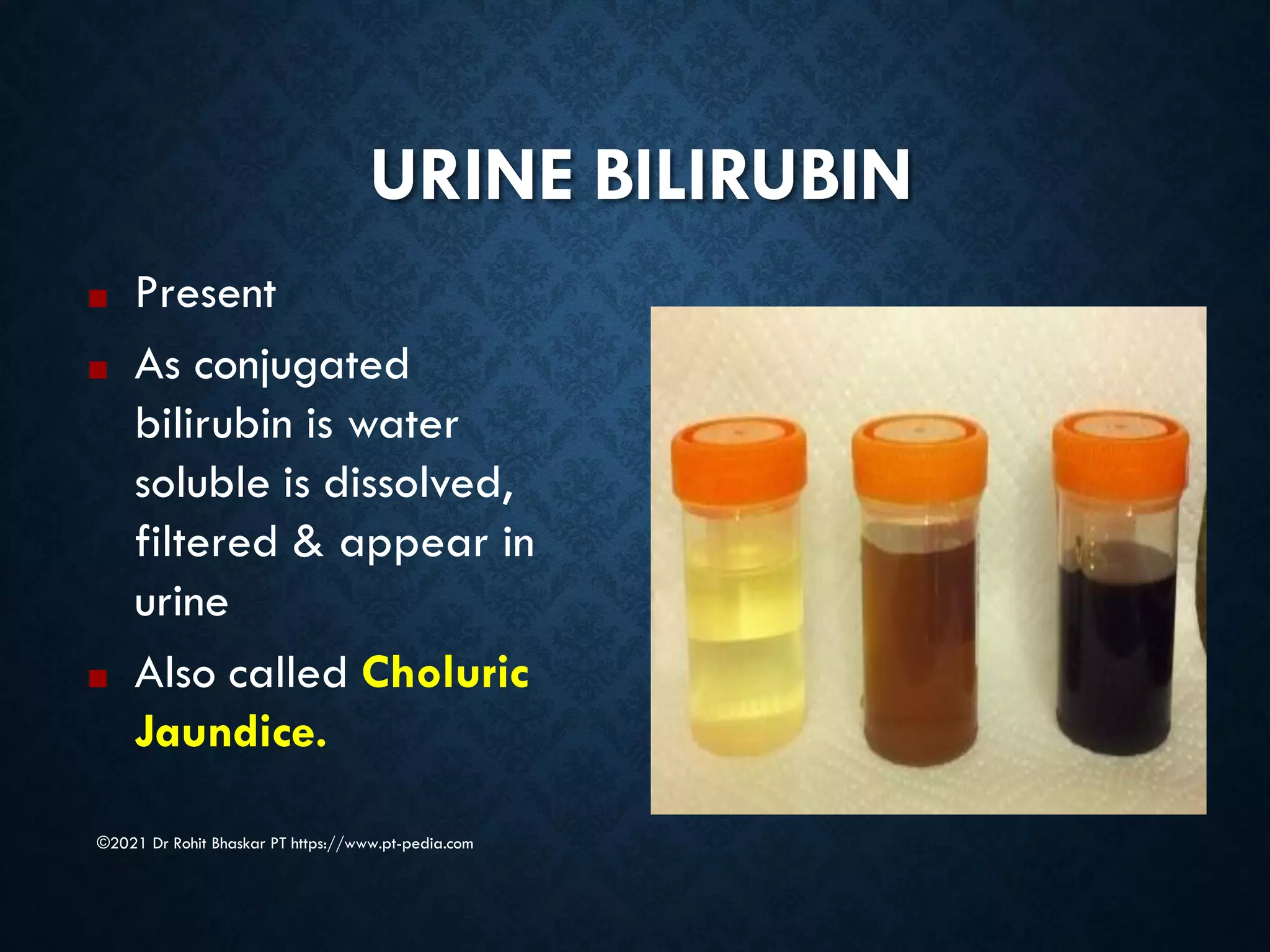 URINE BILIRUBIN
©2021 Dr Rohit Bhaskar PT https://www.pt-pedia.com
■ Present
■ As conjugated
bilirubin is water
soluble is dissolved,
filtered & appear in
urine
■ Also called Choluric
Jaundice.
 