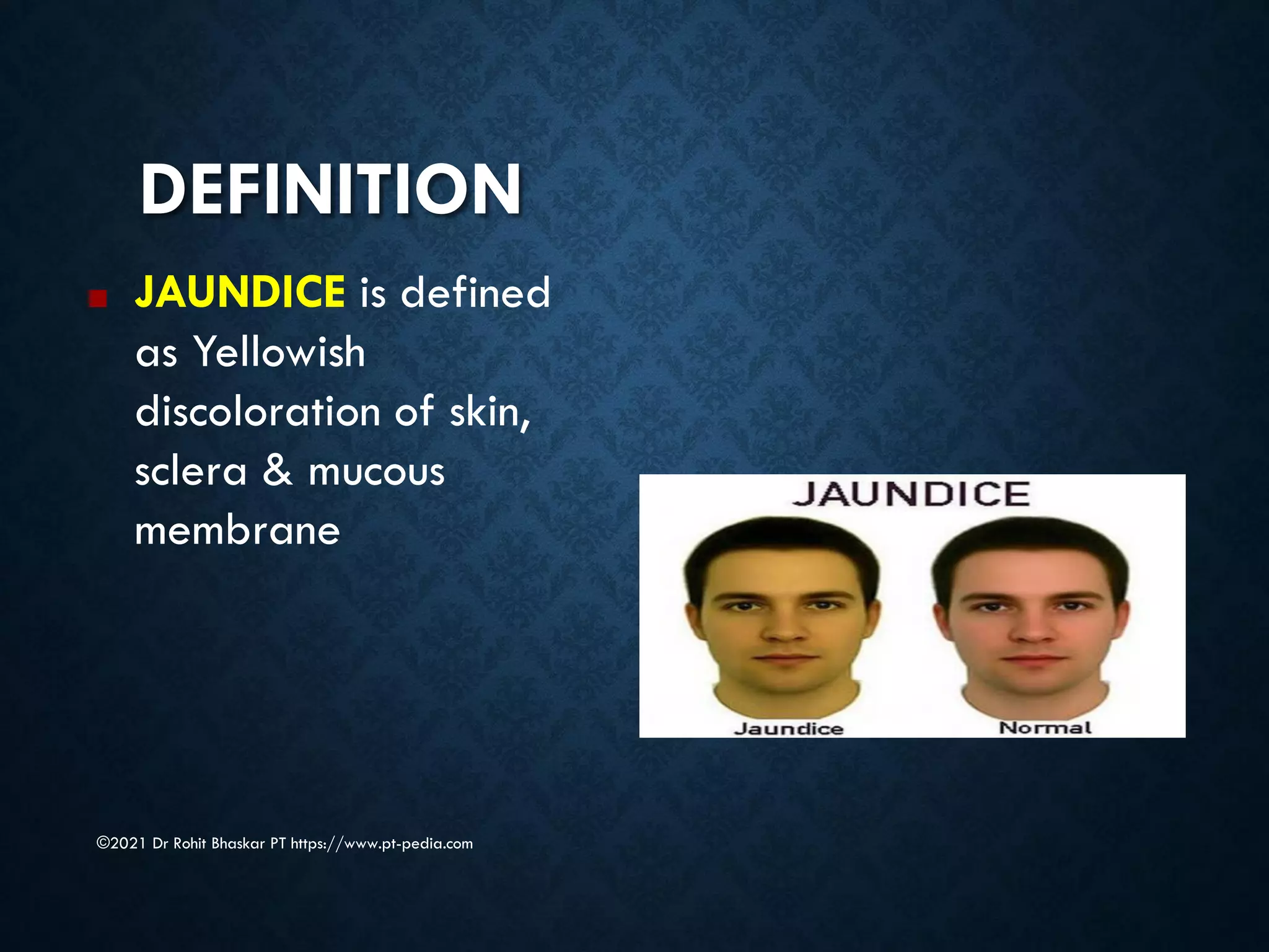 DEFINITION
©2021 Dr Rohit Bhaskar PT https://www.pt-pedia.com
■ JAUNDICE is defined
as Yellowish
discoloration of skin,
sclera & mucous
membrane
 