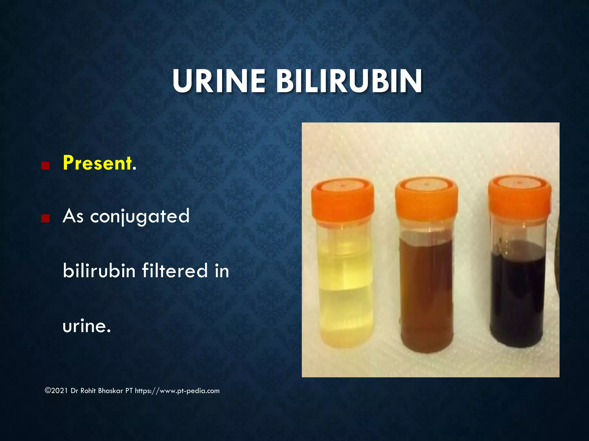 URINE BILIRUBIN
©2021 Dr Rohit Bhaskar PT https://www.pt-pedia.com
■ Present.
■ As conjugated
bilirubin filtered in
urine.
 