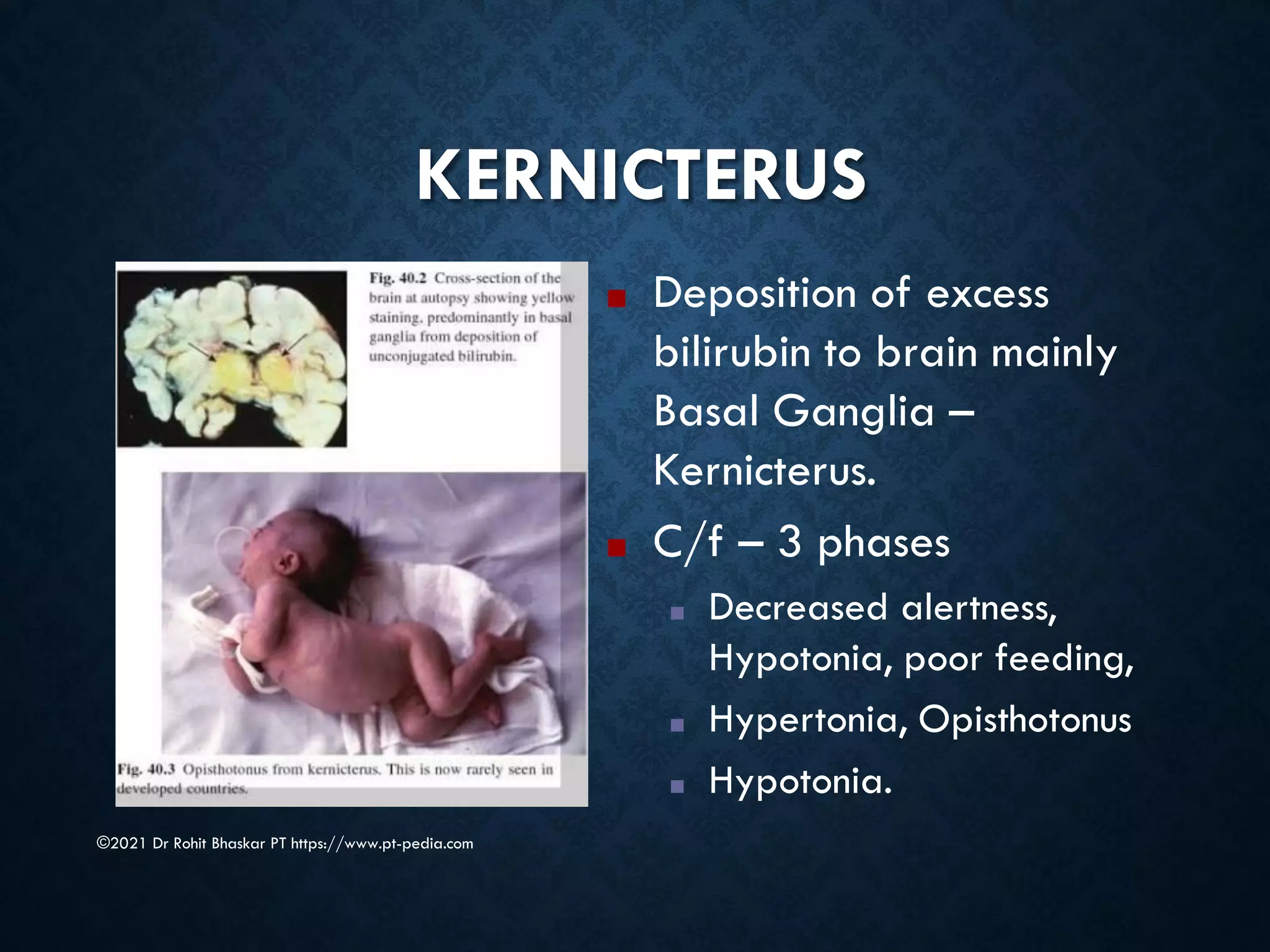 KERNICTERUS
©2021 Dr Rohit Bhaskar PT https://www.pt-pedia.com
■ Deposition of excess
bilirubin to brain mainly
Basal Ganglia –
Kernicterus.
■ C/f – 3 phases
■ Decreased alertness,
Hypotonia, poor feeding,
■ Hypertonia, Opisthotonus
■ Hypotonia.
 