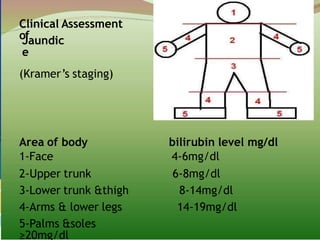 Clinical Assessment
of
Jaundic
e
(Kramer’s staging)
Area of body bilirubin level mg/dl
1-Face 4-6mg/dl
2-Upper trunk 6-8mg/dl
3-Lower trunk &thigh 8-14mg/dl
4-Arms & lower legs 14-19mg/dl
5-Palms &soles
≥20mg/dl
 