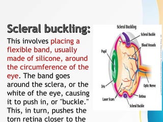 This involves placing a
flexible band, usually
made of silicone, around
the circumference of the
eye. The band goes
around the sclera, or the
white of the eye, causing
it to push in, or "buckle."
This, in turn, pushes the
torn retina closer to the
 