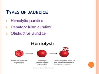 JAUNDICE. GI disorders ... everything... | PPTX