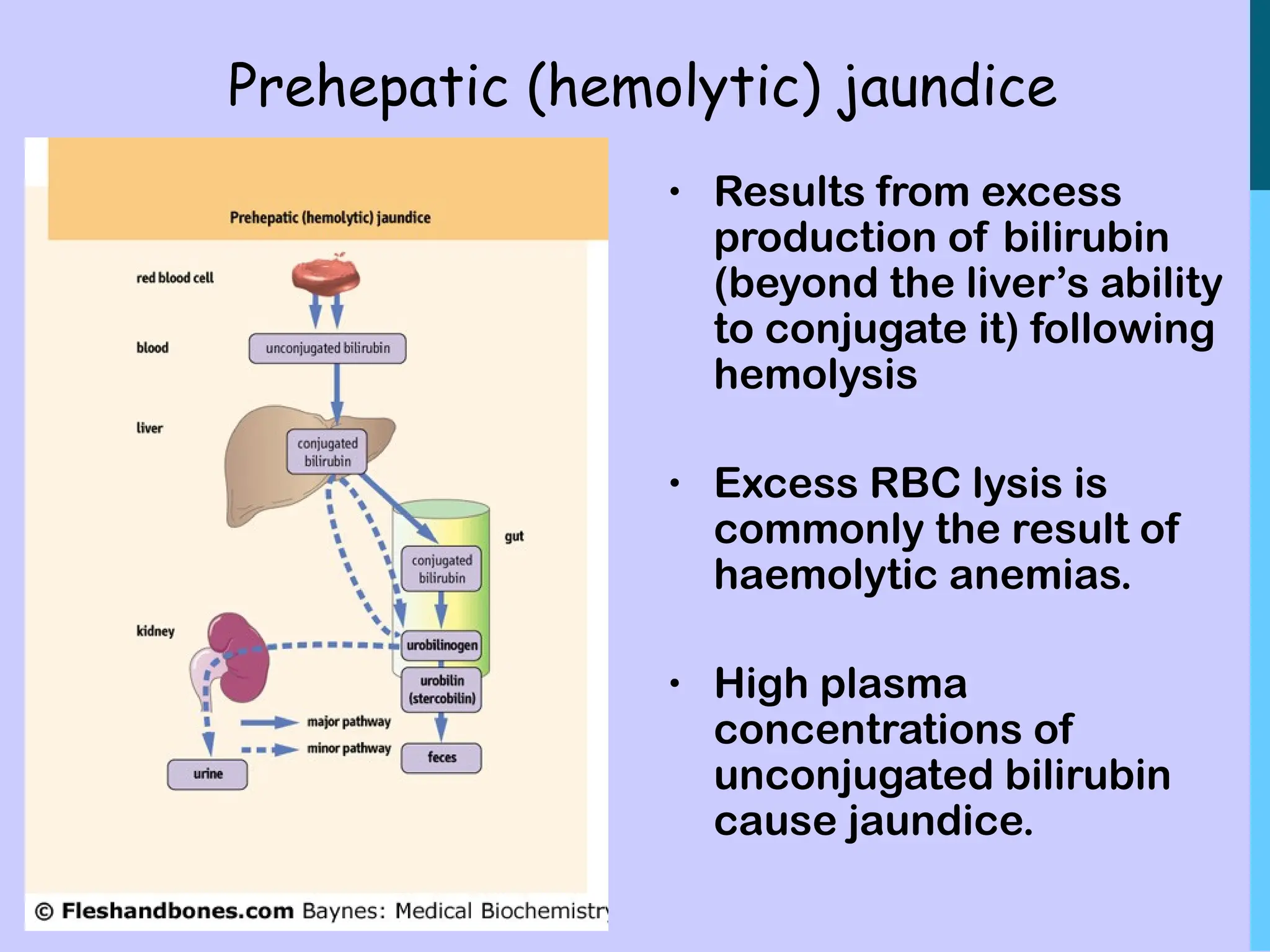 Prehepatic (hemolytic) jaundice
• Results from excess
production of bilirubin
(beyond the liver’s ability
to conjugate it) following
hemolysis
• Excess RBC lysis is
commonly the result of
haemolytic anemias.
• High plasma
concentrations of
unconjugated bilirubin
cause jaundice.
 