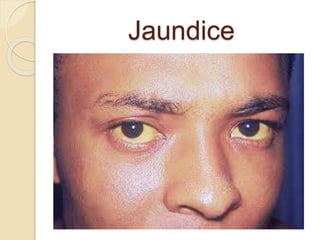 Jaundice
 