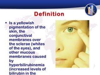 Definition
• Is a yellowish
  pigmentation of the
  skin, the
  conjunctival
  membranes over
  the sclerae (whites
  of the eyes), and
  other mucous
  membranes caused
  by
  hyperbilirubinemia
  (increased levels of
  bilirubin in the
 