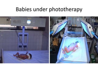 Babies under phototherapy
Baby under conventional
phototherapy
Baby under triple unit intense
phototherapy
 