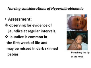 Nursing considerations of Hyperbilirubinemia
• Assessment:
 observing for evidence of
jaundice at regular intervals.
 Jaundice is common in
the first week of life and
may be missed in dark skinned
babies
Blanching the tip
of the nose
 