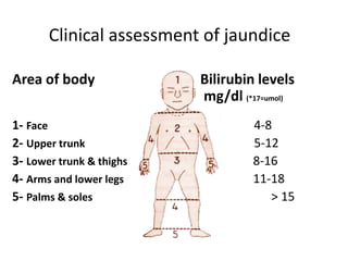 Clinical assessment of jaundice
Area of body Bilirubin levels
mg/dl (*17=umol)
1- Face 4-8
2- Upper trunk 5-12
3- Lower trunk & thighs 8-16
4- Arms and lower legs 11-18
5- Palms & soles > 15
 