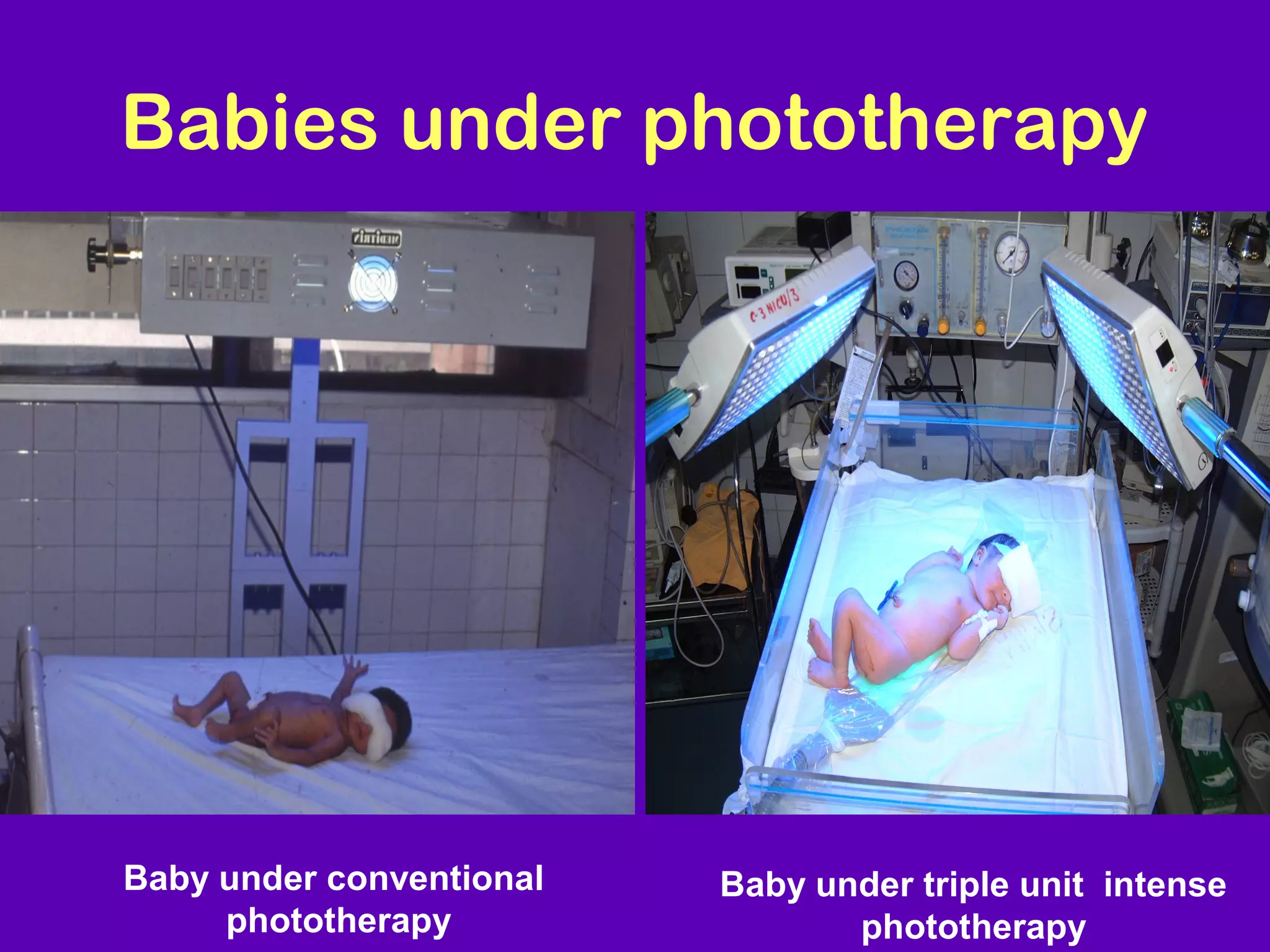 Babies under phototherapy




Baby under conventional   Baby under triple unit intense
     phototherapy                phototherapy
 