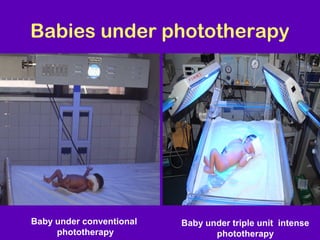 Babies under phototherapy




Baby under conventional   Baby under triple unit intense
     phototherapy                phototherapy
 