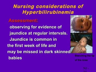 Nursing considerations of
        Hyperbilirubinemia
•   Assessment:
 observing for evidence of
  jaundice at regular intervals.
 Jaundice is common in
 the first week of life and
 may be missed in dark skinned
                                   Blanching the tip
  babies                           of the nose


                                          NJ -
 