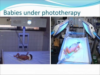 Babies under phototherapy
Baby under conventional
phototherapy
Baby under triple unit intense
phototherapy
 
