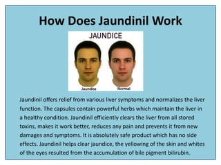 How Does Jaundinil Work
Jaundinil offers relief from various liver symptoms and normalizes the liver
function. The capsules contain powerful herbs which maintain the liver in
a healthy condition. Jaundinil efficiently clears the liver from all stored
toxins, makes it work better, reduces any pain and prevents it from new
damages and symptoms. It is absolutely safe product which has no side
effects. Jaundinil helps clear jaundice, the yellowing of the skin and whites
of the eyes resulted from the accumulation of bile pigment bilirubin.
 