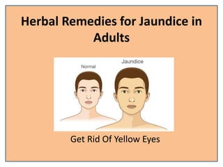 Herbal Remedies for Jaundice in
Adults
Get Rid Of Yellow Eyes
 