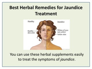Best Herbal Remedies for Jaundice
Treatment
You can use these herbal supplements easily
to treat the symptoms of jaundice.
 