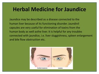 Herbal Medicine for Jaundice
Jaundice may be described as a disease connected to the
human liver because of its functioning disorder. Jaundinil
capsules are very useful for elimination of toxins from the
human body as well asthe liver. It is helpful for any troubles
connected with jaundice, i.e. liver sluggishness, spleen enlargement
and bile flow obstruction etc.
 