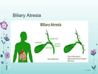 Biliary Atresia
10/14/2015 86
 
