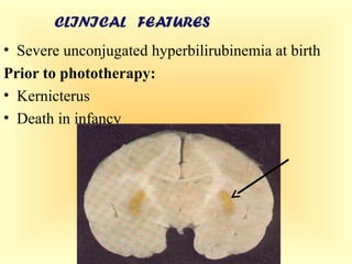 Kernicterus Features DR MUHAMMAD MUSTANSAR FJMC LAHORE | PPT