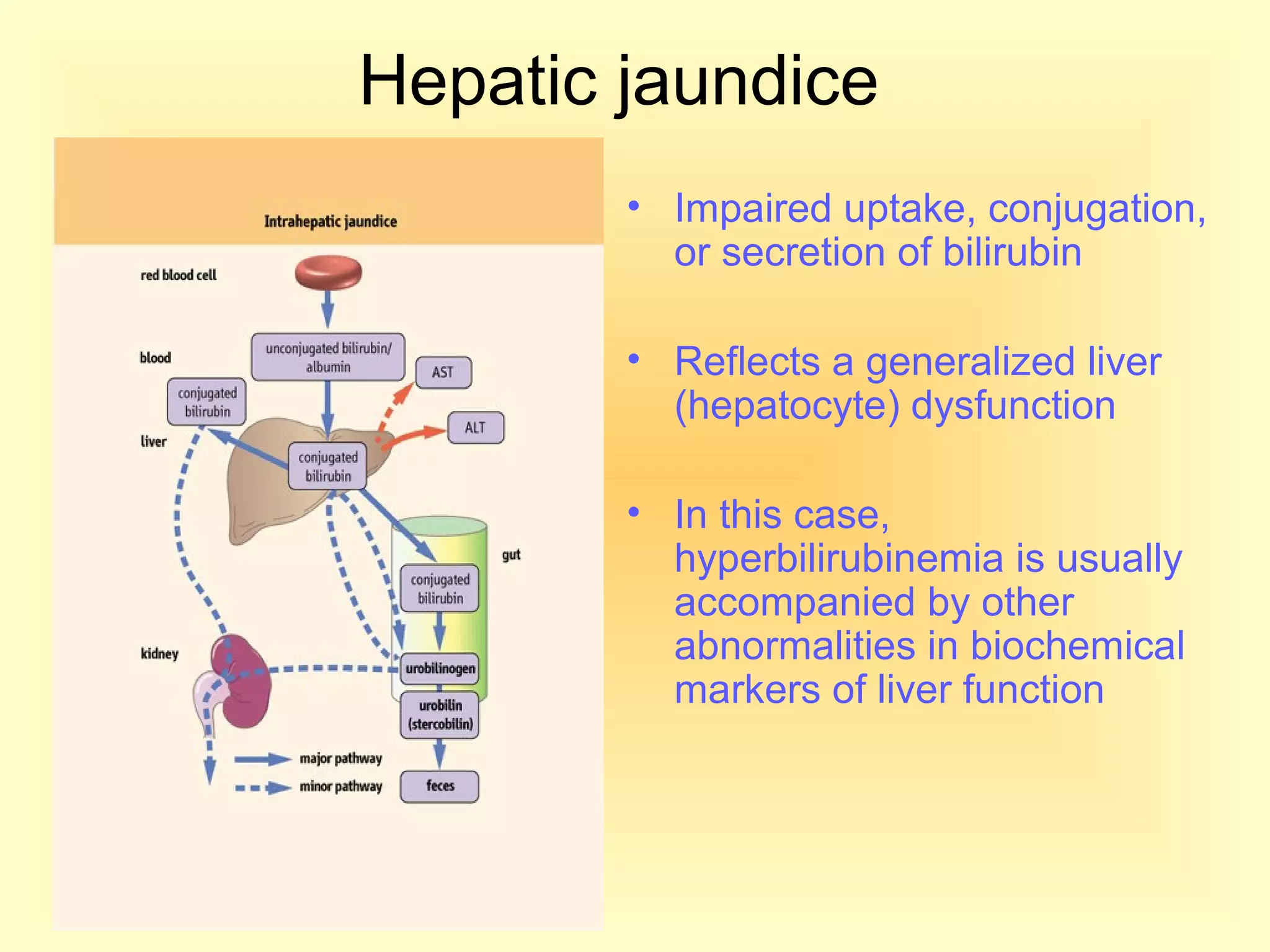Hepatic jaundice
• Impaired uptake, conjugation,
or secretion of bilirubin
• Reflects a generalized liver
(hepatocyte) dysfunction
• In this case,
hyperbilirubinemia is usually
accompanied by other
abnormalities in biochemical
markers of liver function
 