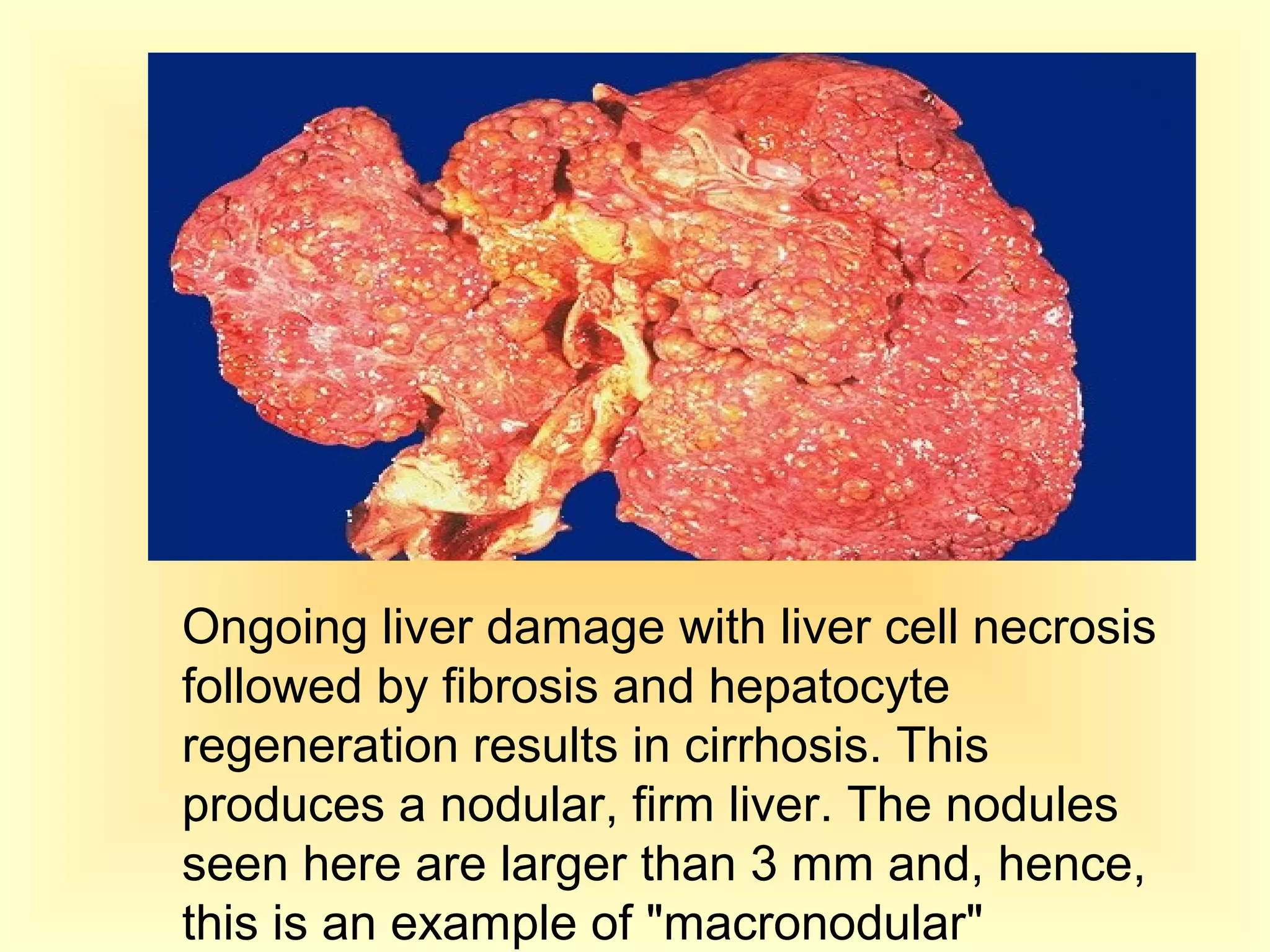 Ongoing liver damage with liver cell necrosis
followed by fibrosis and hepatocyte
regeneration results in cirrhosis. This
produces a nodular, firm liver. The nodules
seen here are larger than 3 mm and, hence,
this is an example of "macronodular"
 