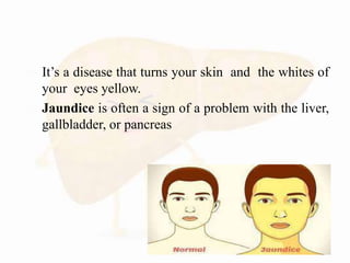  It’s a disease that turns your skin and the whites of
your eyes yellow.
 Jaundice is often a sign of a problem with the liver,
gallbladder, or pancreas
 