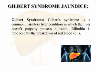  Gilbert Syndrome: Gilbert's syndrome is a
common, harmless liver condition in which the liver
doesn't properly process bilirubin. Bilirubin is
produced by the breakdown of red blood cells.
 