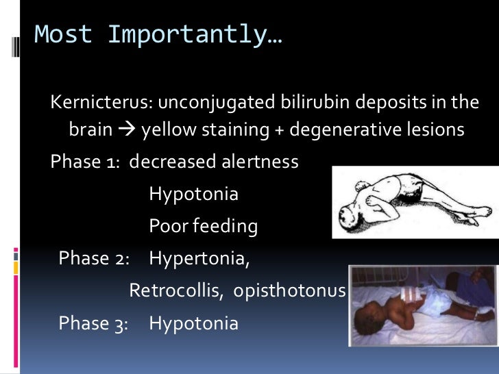 Jaundice presentation